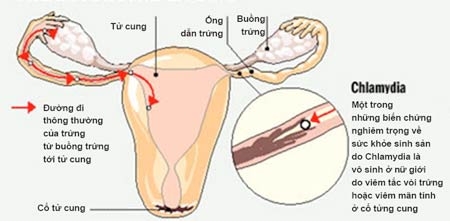 Chlamydia - Hình ảnh minh họa